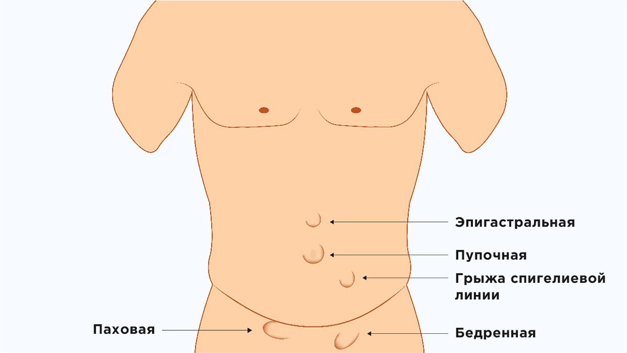 Коррекция пупка